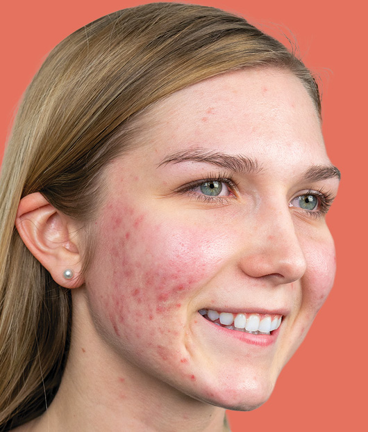 Close-up of woman with acne of her face staring off to the side. 