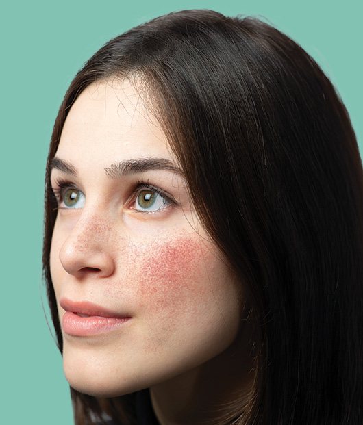 Close-up of woman with irritated skin on her face in front of a light green background. 