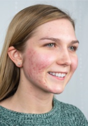 Before treatment: example two